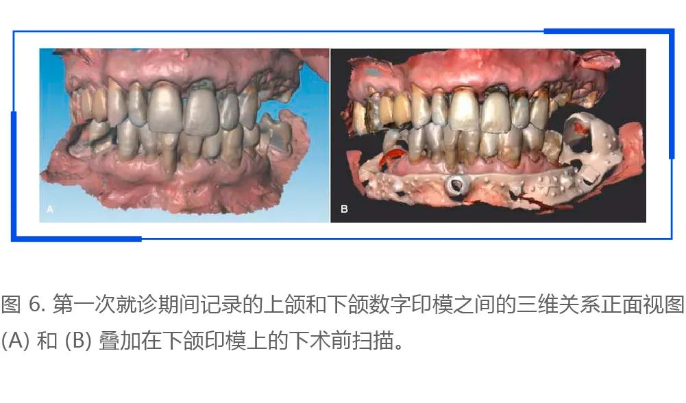 利用口腔掃描儀進行術前口內(nèi)掃描和數(shù)字化設計